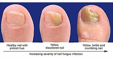 The manifestation of nail fungus