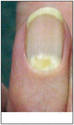 Fungus for proximal deformation