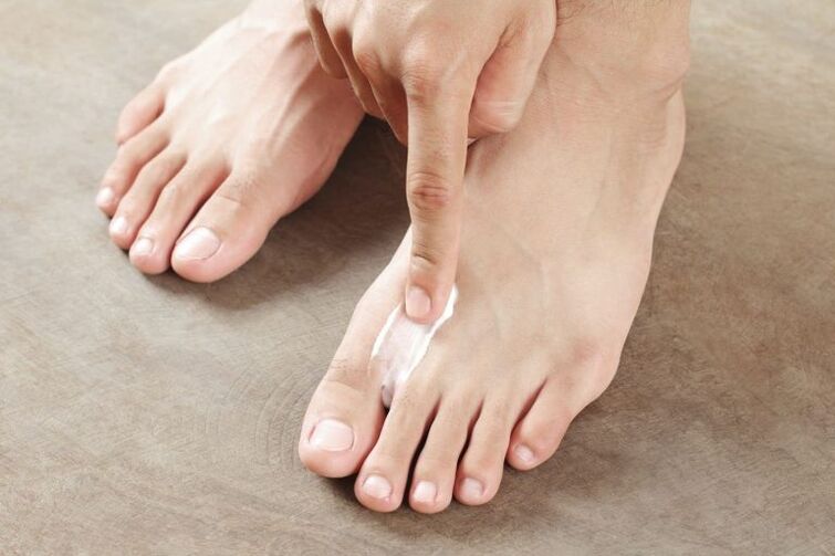 Apply an antifungal cream on the skin of the foot