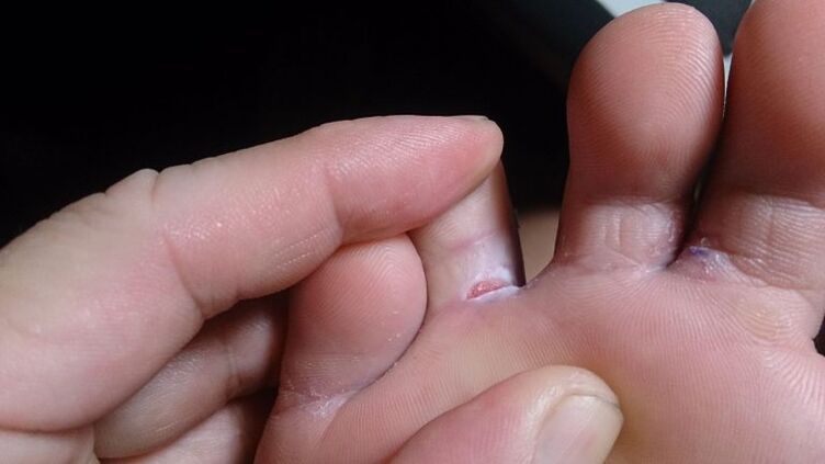 Fungus between the fingers