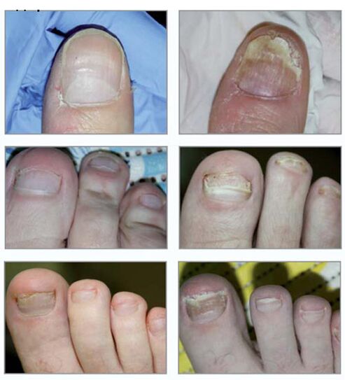 Nail fungus