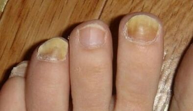 The reasons for the appearance of nail fungus