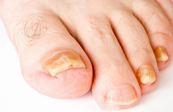 Nail fungus