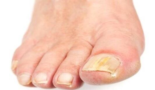 Nail yellowing due to a fungal infection