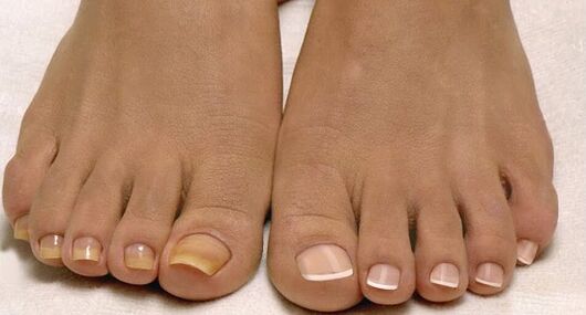 Normal nail fungus and nail nails