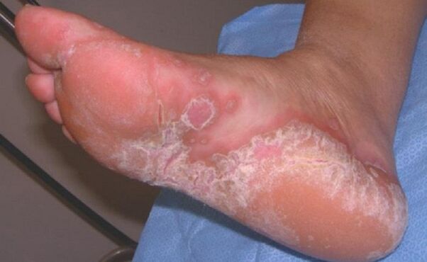 symptoms of fungus on the feet