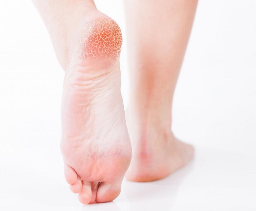 fungal infection of the feet