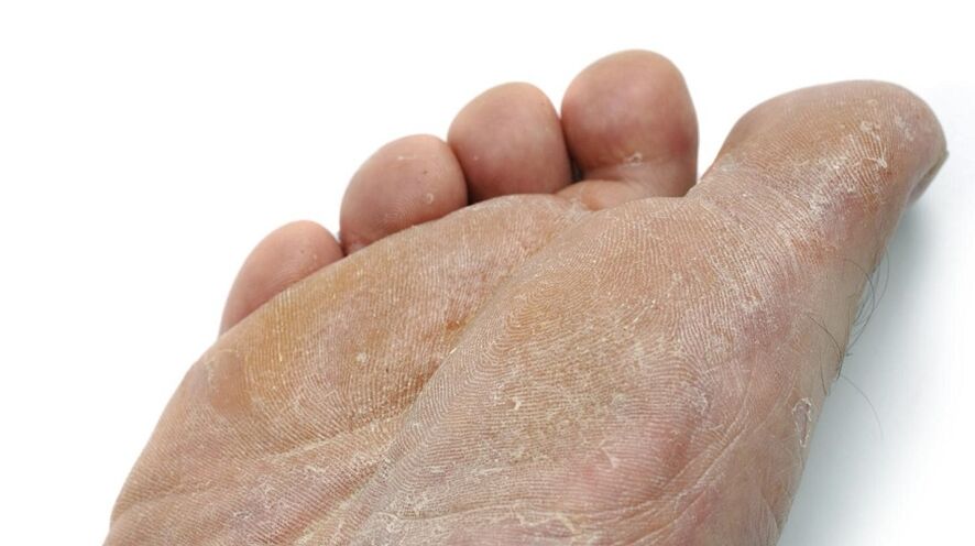 symptoms of foot fungus