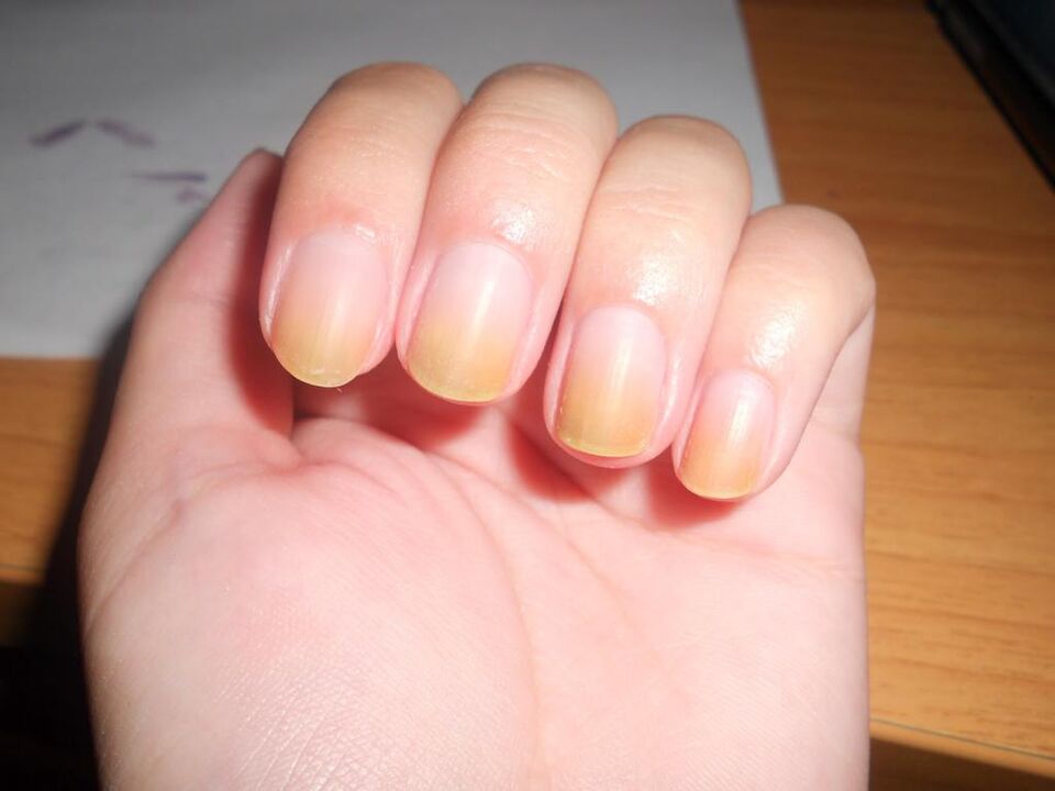 nail fungus symptoms
