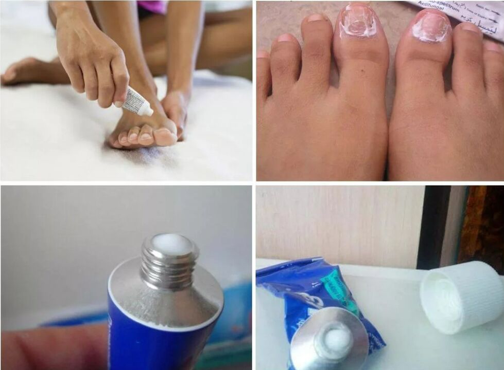 remedy for toenail fungus