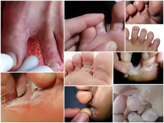 symptoms of fungus between the toes photo 2