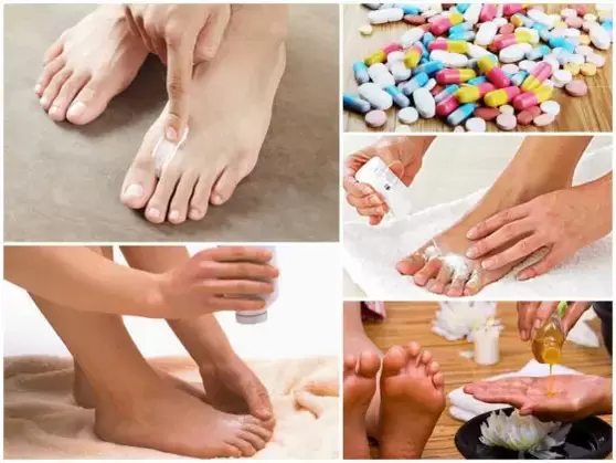 ways to treat fungus between the toes
