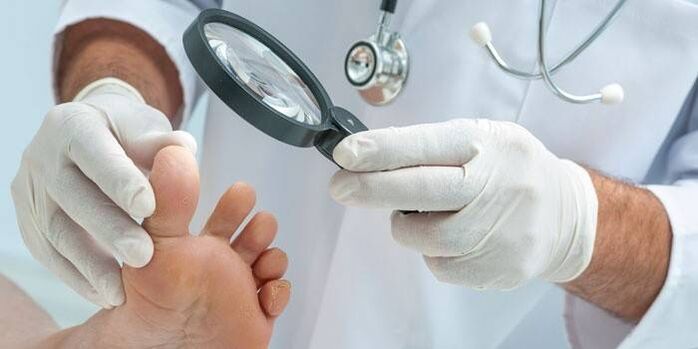 a doctor examines the feet for fungus between the toes