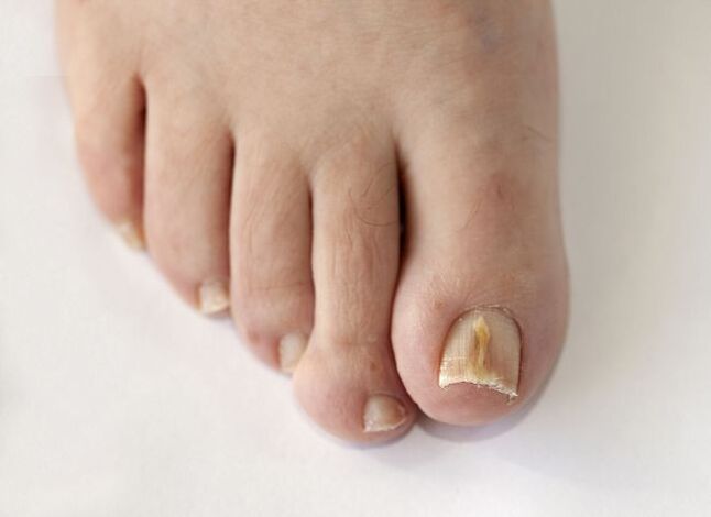 Nail discoloration due to fungal growth